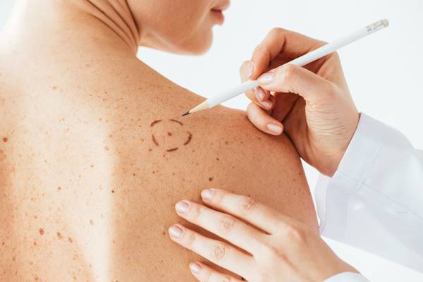 What is malignant melanoma? Signs, symptoms, treatment