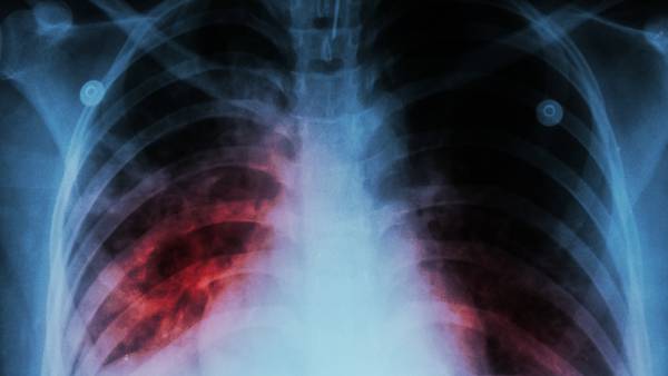 At least 14 sickened from outbreak of tuberculosis