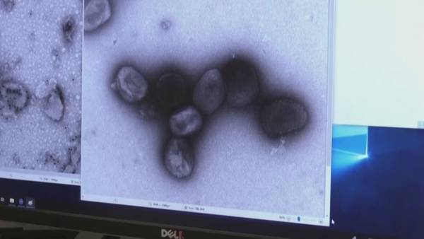 Second probable case of monkeypox being investigated in Pierce County