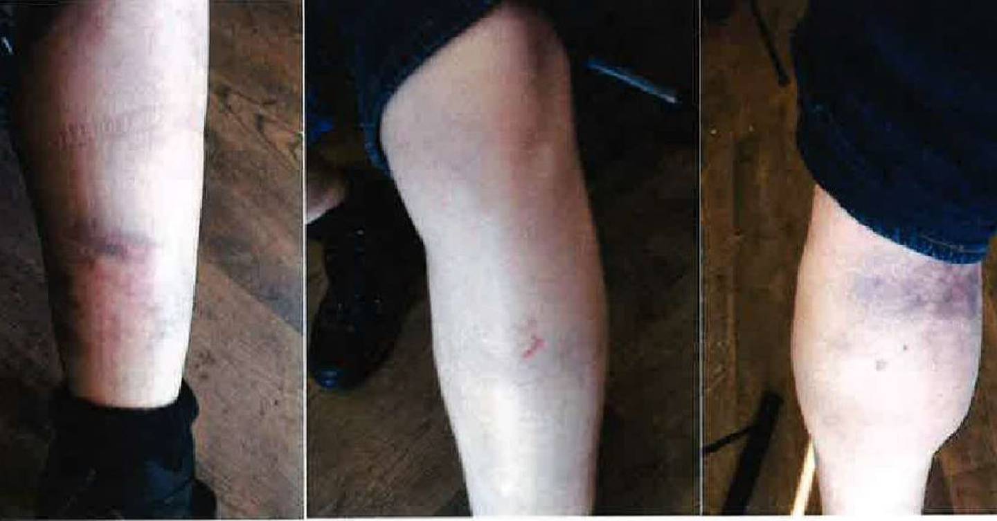 Richard Weisgerber's legs after attack