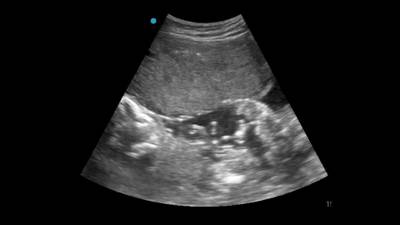 Ultrasound of pregnant gorilla